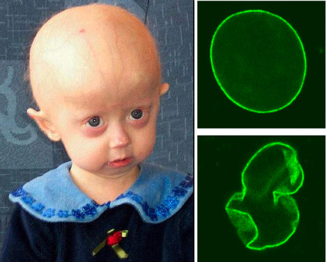 weird-diseases-progeria